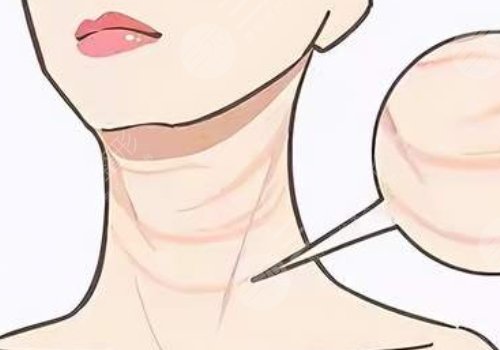 頸紋填充能維持多久呢？色素沉著能消退嗎？