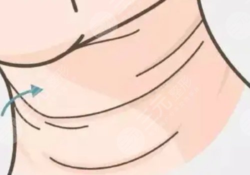 頸紋填充能維持多久呢？色素沉著能消退嗎？