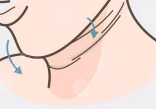 頸紋是什么原因造成的?