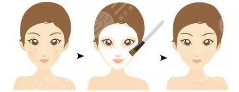 果酸換膚注意的事項有哪些?