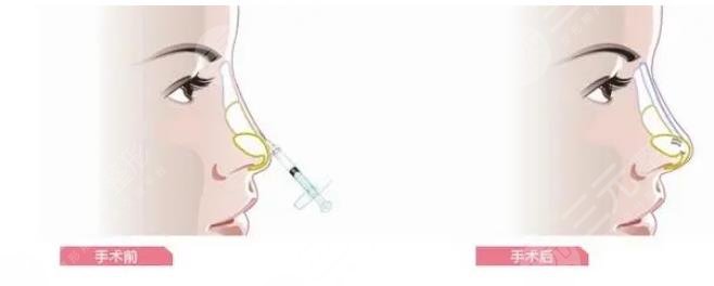 玻尿酸隆鼻價(jià)格是多少