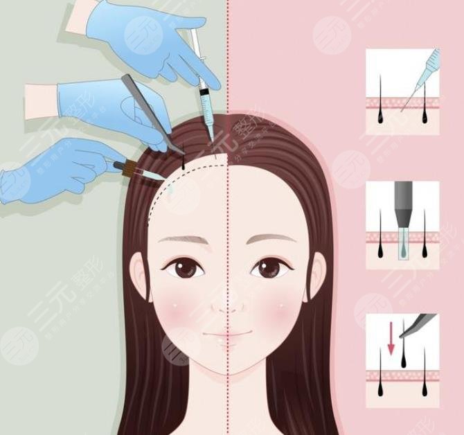 禿頂植發(fā)需要多少錢