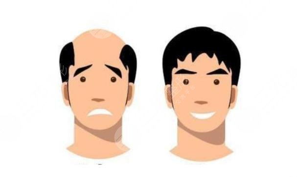 禿頂植發(fā)需要多少錢