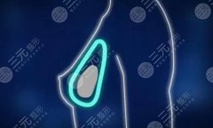 德國寶儷與美國曼托哪一個(gè)貴？原理、優(yōu)勢(shì)、價(jià)格對(duì)比