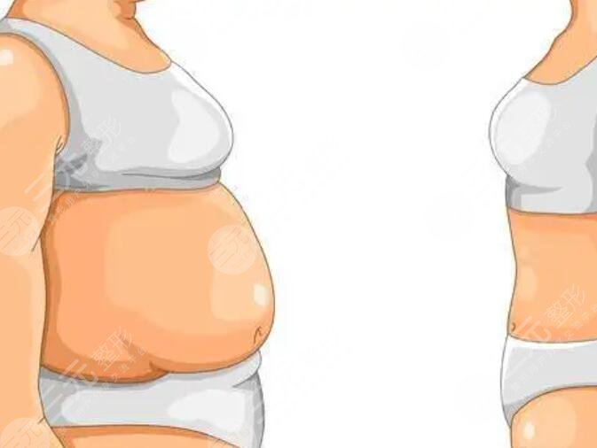 光纖溶脂術后護理方法有哪些?