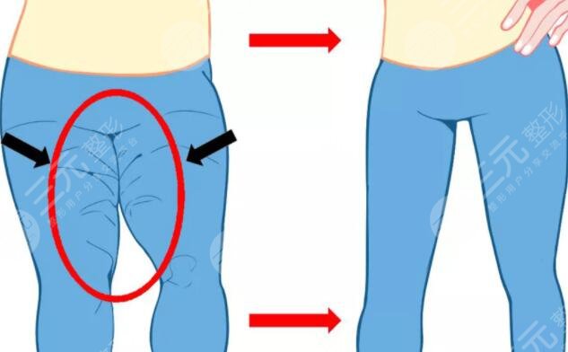 光纖溶脂術后護理方法有哪些?