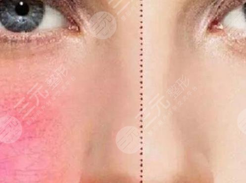 紅血絲激光多少錢