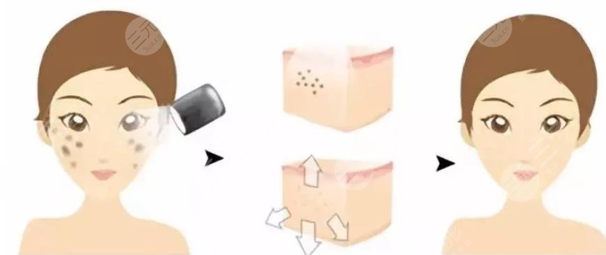 復合彩光緩解多少錢