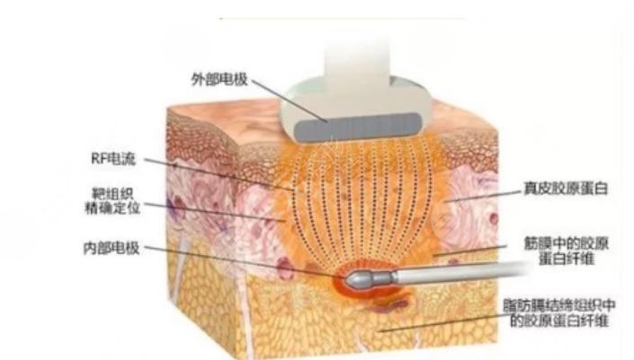 復合彩光緩解多少錢