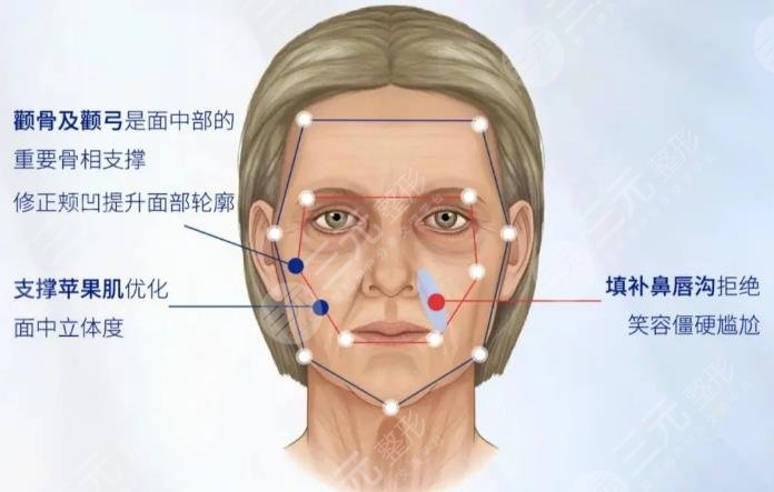 內(nèi)輪廓提升