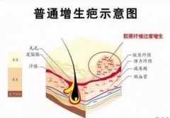 有傷疤怎么去掉？疤痕修復(fù)4種方案分享，無懼瑕疵！