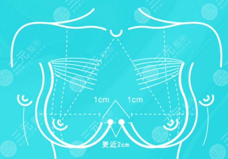 極速豐胸靠譜嗎?