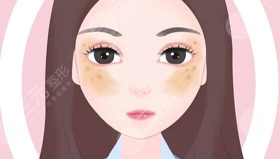 去除黃褐斑價(jià)格大概是多少?