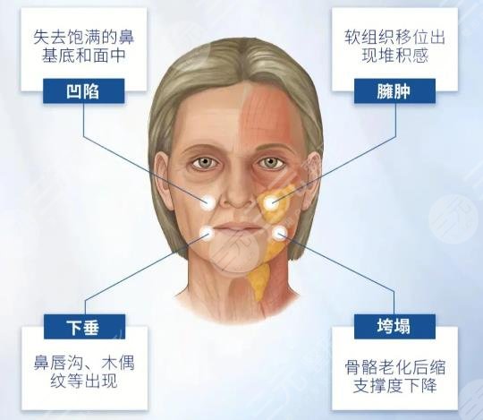 蘋果肌復(fù)位