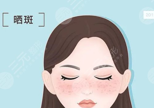 曬斑如何淡化或去掉？