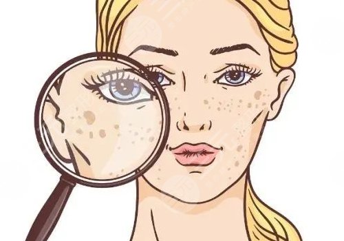 曬斑如何淡化或去掉？
