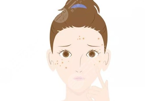 曬斑如何淡化或去掉？