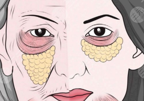 多維平復祛眼袋是什么？