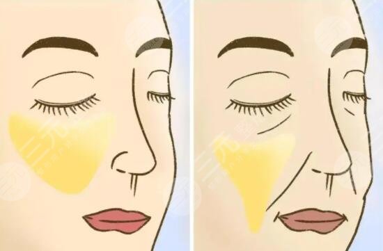 面部下垂整形手術(shù)費(fèi)用大概多少2023？為何價(jià)格有高有低？影響因素是啥？