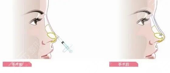 玻尿酸隆鼻可以維持多久時間?