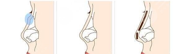 自體軟骨隆鼻好嗎有效果嗎?