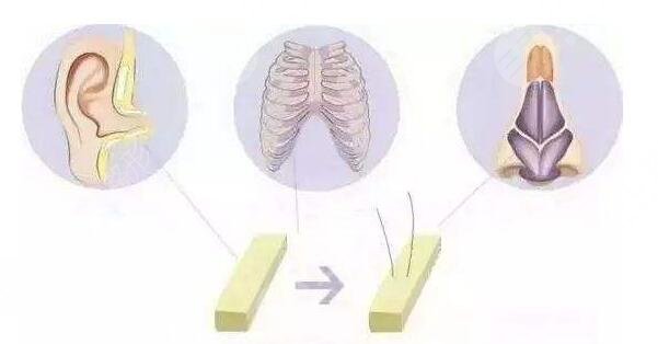 做自體軟骨鼻需要多少錢?