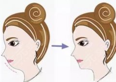 膨體墊下巴注意事項(xiàng)有哪些？技術(shù)優(yōu)點(diǎn)_會(huì)留下疤痕嗎