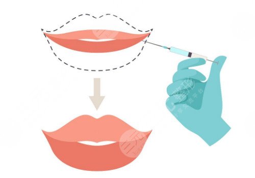 唇部注射玻尿酸需要注意什么？