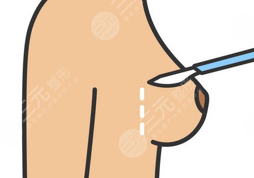 假體隆胸哪個切口好？恢