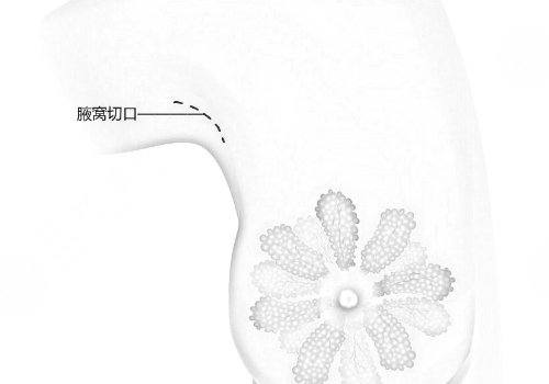 假體隆胸哪個切口好？恢