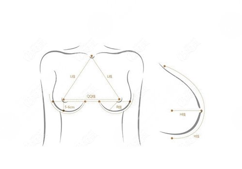 假體隆胸哪個切口好？恢