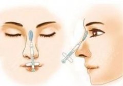 玻尿酸隆鼻有副作用嗎？可以維持多久？一文全了解