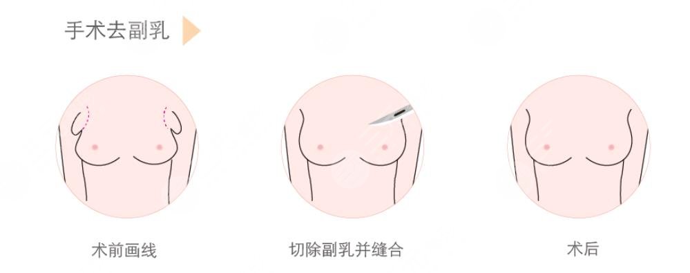 腋下副乳運(yùn)動(dòng)消除方法