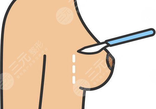 隆胸腋下切口的優(yōu)勢和缺點有哪些？