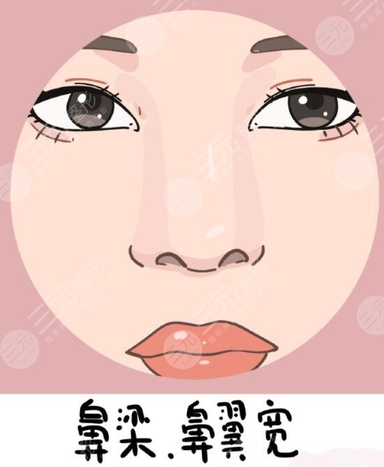 硅膠隆鼻前后對比效果差距明顯，直男看了都直呼‘側顏殺手’