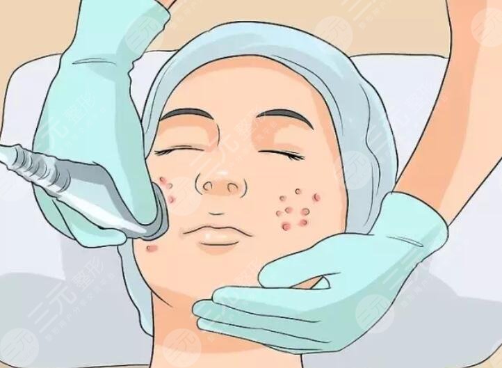 激光磨皮去痘印多少錢一般?