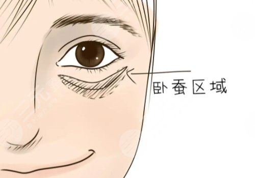 注射臥蠶后會(huì)變成眼袋嗎？