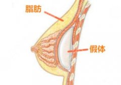 假體豐胸如何避免包膜痙攣？3-6個(gè)月的恢復(fù)期要注意護(hù)理！