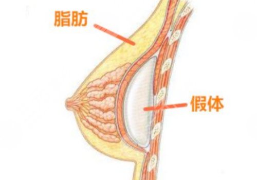 假體豐胸如何避免包膜痙攣？