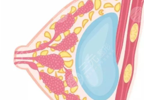 假體豐胸如何避免包膜痙攣？