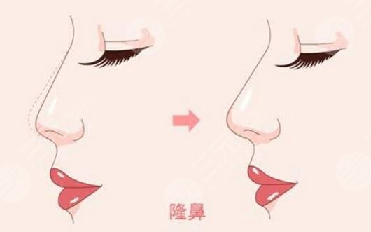 鼻翼整形手術(shù)多少錢