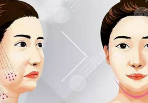 臉部輪廓固定怎么做？