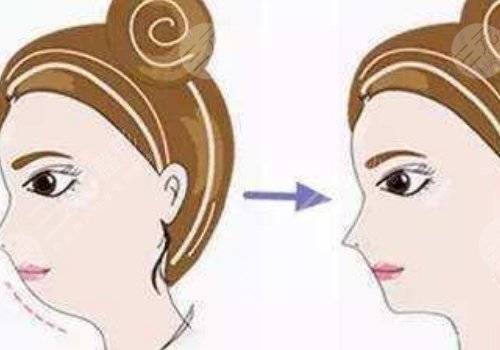 臉部輪廓固定怎么做？