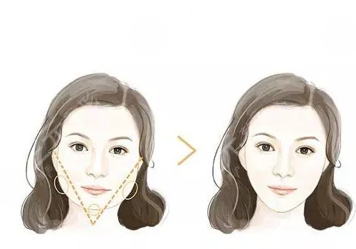 臉部輪廓固定怎么做？