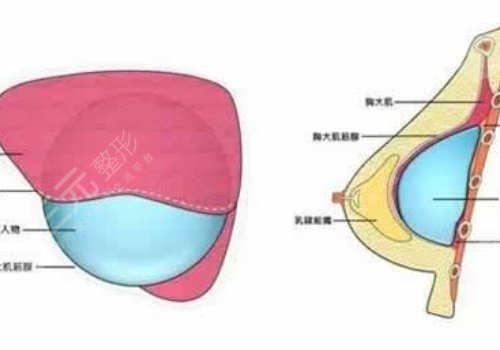 光面假體隆胸后需要怎么樣按摩？