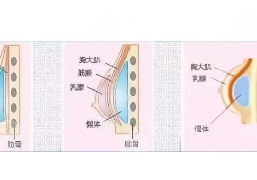 光面假體隆胸后需要怎么樣按摩？