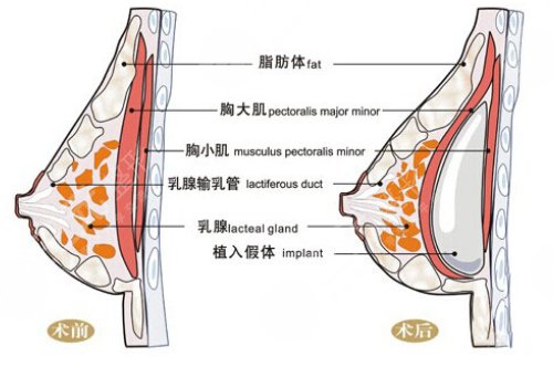 光面假體隆胸后需要怎么樣按摩？