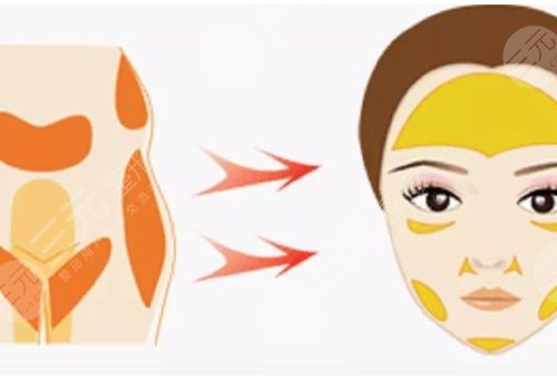 面部脂肪填充的好處和壞處有哪些