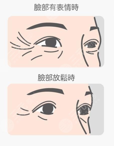 祛除魚尾紋快的方法有哪些?