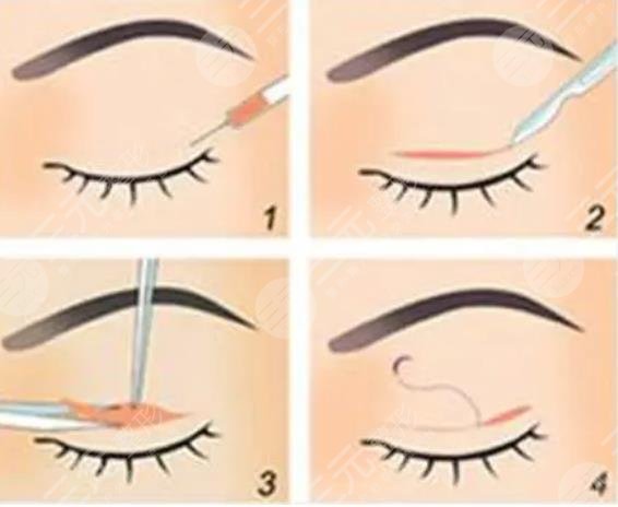 雙眼皮術(shù)前準(zhǔn)備